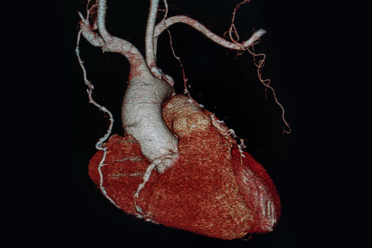 X-ray medical scan heart in hospital. CTA, CT angiography 3D rendering image, CT Scan. Healthcare and Medical concept.