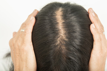 .Scalp and thin hair, hair removal Thin hair and scalp and broken hair - obrazy, fototapety, plakaty