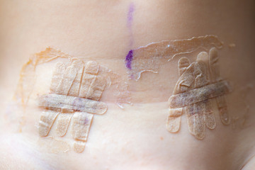 Patch after surgery of undescended testicles on the skin of a young male toddler