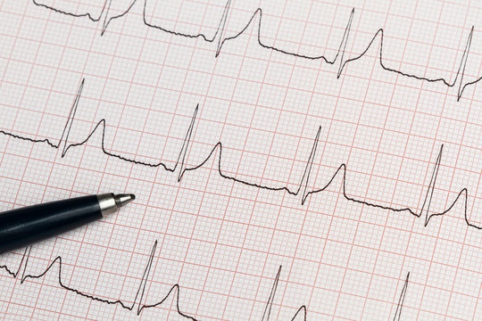 Electrocardiograma papel informe junto a un bol&iacute;grafo. Vista superior. Concepto: Salud Medicina