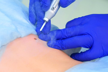 Process removing mole using laser on patient back by surgeon, closeup view after procedure. One day...