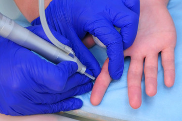 Surgeon removing wart on finger using laser, hands closeup. Remove verruca on hand finger. One day...