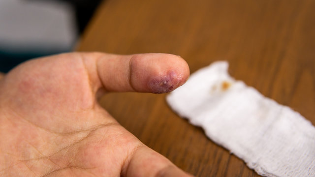 An infection wound with pus inside the thumb on the white bandage with blood stains. Hygiene, infected.