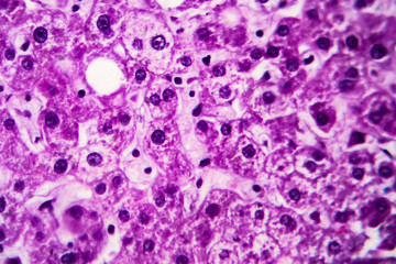 Cloudy swelling of the liver, light micrograph, photo under microscope. High magnification