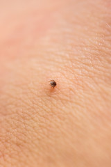Tick with its chelicerae sticking in human skin.
