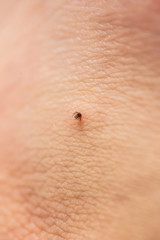 Tick with its chelicerae sticking in human skin.