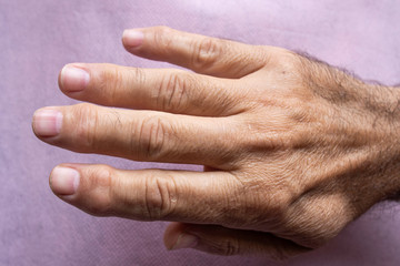 Fingers with arthrosis and pain