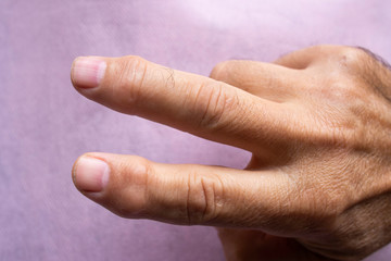 Fingers with arthrosis and pain