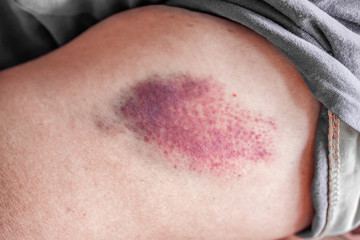 Fototapeta premium large injection bruised on woman arm closeup 