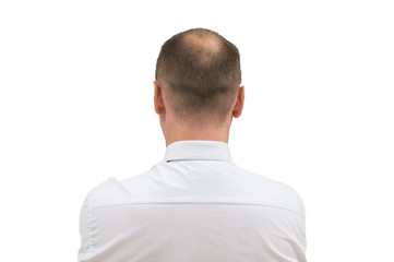 Human alopecia or hair loss - adult men bald head. back of balding man from shoulders isolated on white background