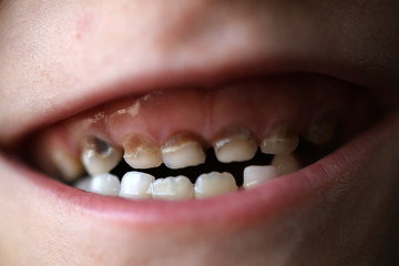 Obraz premium decayed tooth