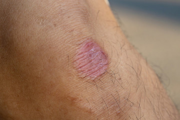 Fototapeta premium Ring Worm infection, Dermatophytosis on skin. Ringworm infection or Tinea on skin. Mycosis infection on the human skin. It is caused by a fungus
