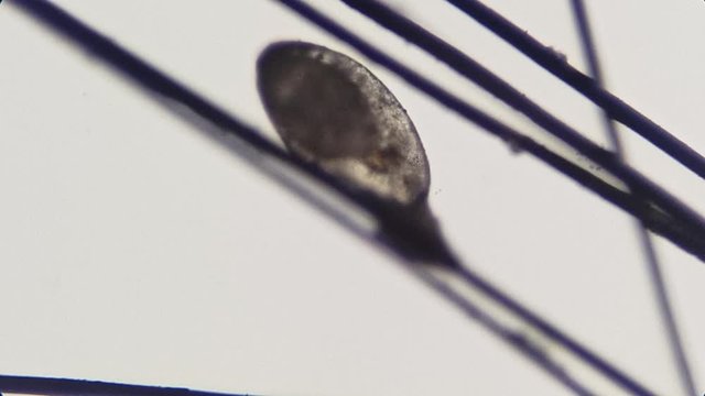Lice invasion, video of lice eggs on hair under high magnification