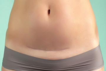 Close up of a caesarean section scar in a woman. Health and childbirth.