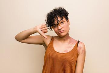 Young african american woman with skin birth mark showing a dislike gesture, thumbs down....