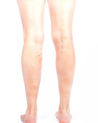 Painful varicose spider veins and on a woman legs, Vascular diseases, Phlebeurysm problems with swollen veins