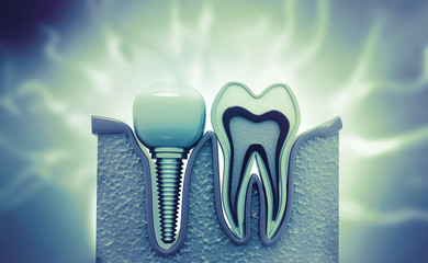 Dental implement on abstract medical background. 3d illustration