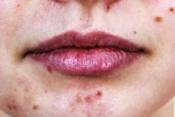Female face with acne skin problem