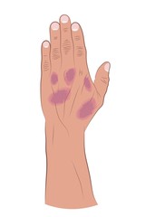 Psoriasis on human hand on white background . Vector illustration