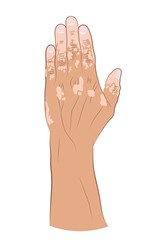 Medical Illustration of the effects of vitiligo