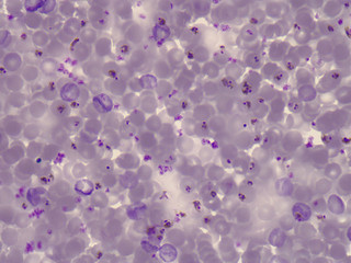 Blood smear of a patient with malaria. Plasmodium falciparum.