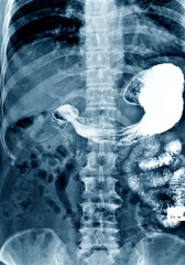 Film x-ray acute abdomen Chest AP,Abdomen view