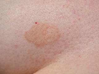 Fungal skin rash infection mark. Close up view of the patch which is darker than the healthy...