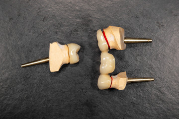 ceramic crowns of human teeth closeup macro isolate on black background. The concept of aesthetic...