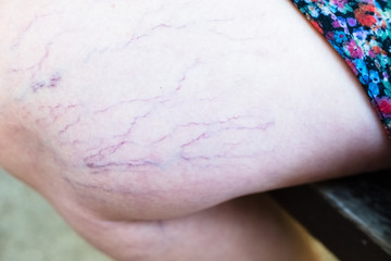 Obraz na płótnie Canvas Detail of varicose veins on the leg of a seated woman.