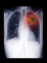 Film x-ray chest radiograph show lung mass. Lung cancer or carcinoma is malignant tumor which can...