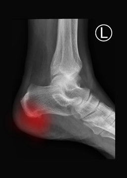 Film X-ray left lateral ankle radiograph showing spur at heel bone (calcaneus). The calcaneal spur cause plantar fasciitis, heel pain (highlight on pain area). medical concept