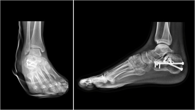 Film ankle X-ray radiograph showing heel bone broken (calcaneus fracture) which treated by open reduction and internal fixation(ORIF) with plate and screws. Medical technology and instrument concept.