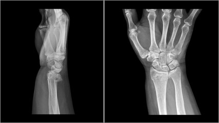 Film X ray wrist radiograph show distal forearm bone broken ( distal end radius fracture). The patient has wrist pain, swelling and deformity. Medical imaging and technology concept