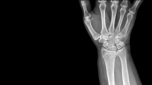 Film X ray wrist radiograph show distal forearm bone broken ( distal end radius fracture). The patient has wrist pain, swelling and deformity. Medical imaging and technology concept