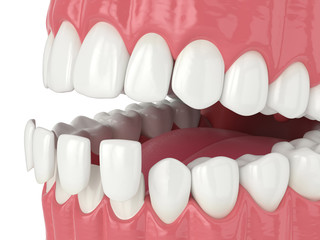 3d render of jaw with lower veneers