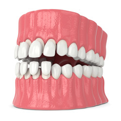 3d render of jaw with upper and lower veneers
