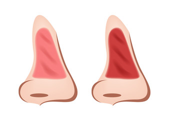 inflammation of nasal mucosa vector / rhinitis