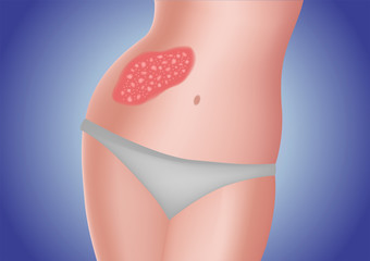 skin disease vector / psoriasis on hip