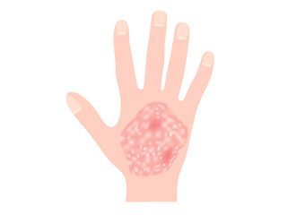 Obraz premium skin disease vector / psoriasis on hand