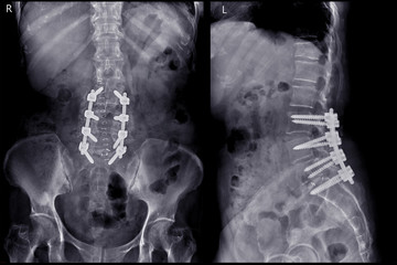 X-ray image of lambosacral spine or L-S spine AP and lateral Post operative  Lumbar Plates and...
