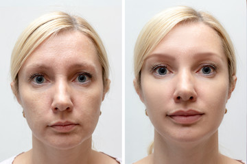 Woman face with wrinkles and age change before and after treatment - the result of rejuvenating cosmetological procedures of biorevitalization, botox face lifting and pigment spots removal