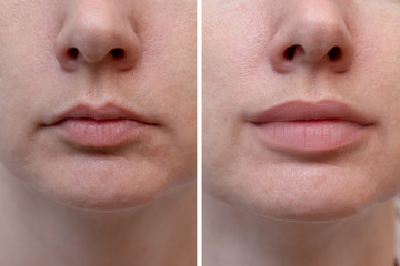 Female lips before and after augmentation, the result of using hyaluronic filler - obrazy, fototapety, plakaty