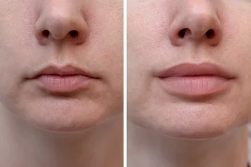 Poster Female lips before and after augmentation, the result of using hyaluronic filler © ReaLiia