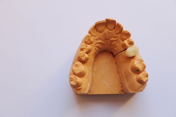 dental cast on a white background