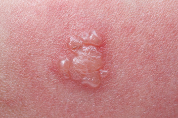 Fototapeta premium Shingles, Zoster or Herpes Zoster symptoms 
