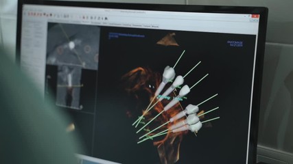 The doctor looks on three-dimensional computer model of dental implants