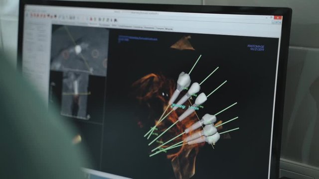 The doctor looks on three-dimensional computer model of dental implants