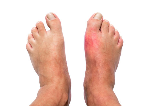 Man with right foot swollen and painful gout inflammation isolated on white background