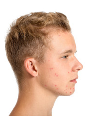 Fototapeta premium Teenage boy with acne problem on white background