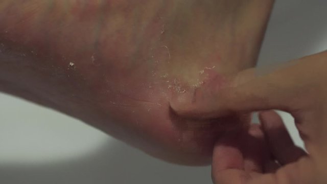 Man Scratching Scab on Heel Caused From Dry Skin